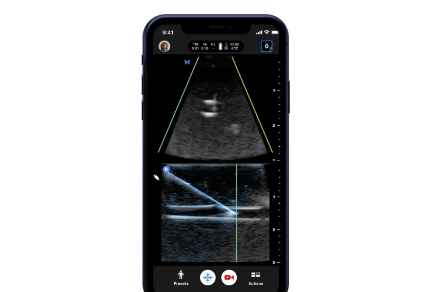 Top Portable Ultrasound Machines Which One To Choose For Your Business