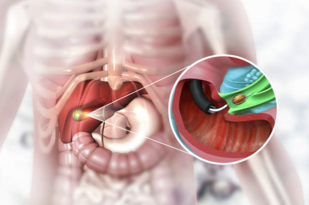 What Types of Damages Can You Seek After a Cholecystectomy Error?