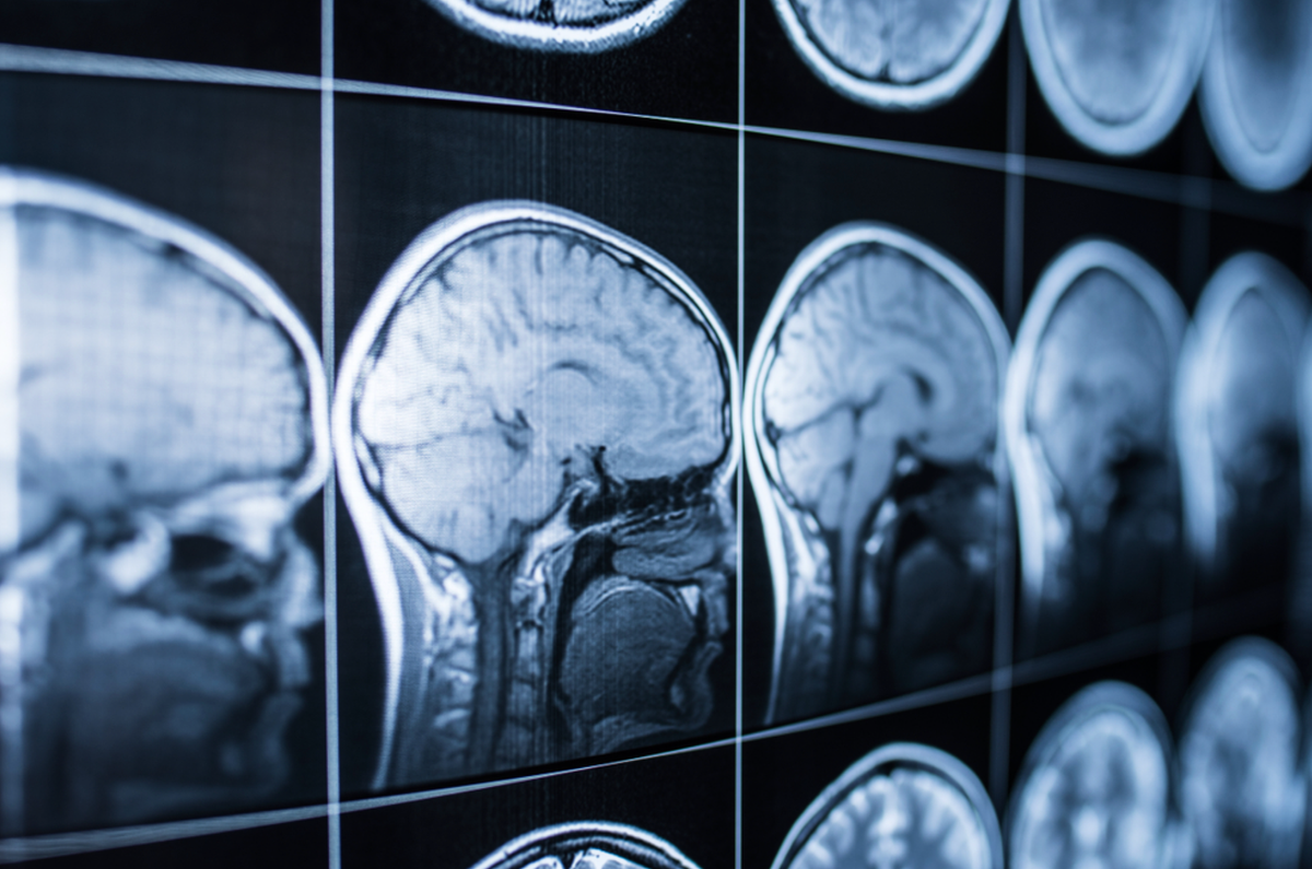 Why Brain Injury Cases Are Harder to Prove Than You Think