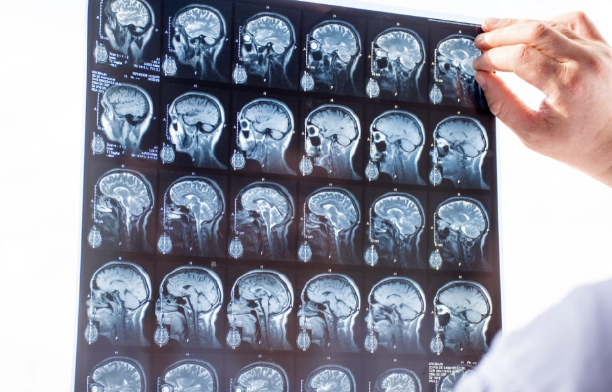 What Makes Traumatic Brain Injury Cases More Complex Than Other Injury Claims