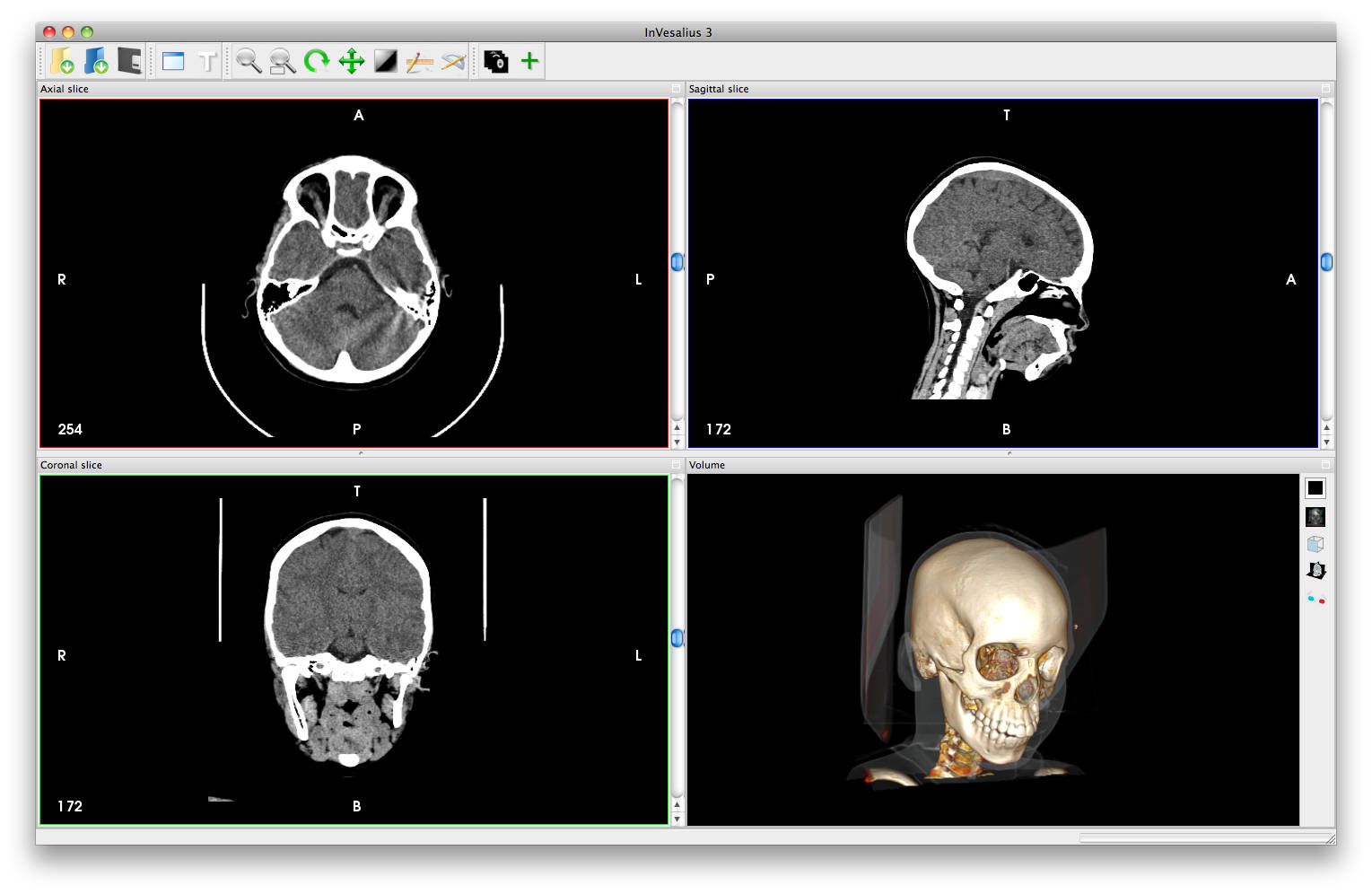 InVesalius: Open source 3D Medical Imaging reconstruction program