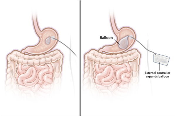 MIT’s New Inflatable Gastric Balloon: A Flexible Solution for Weight Loss Could Be a Game-Changer for Millions