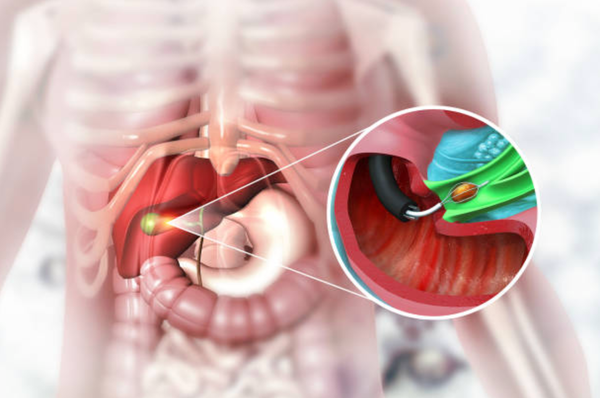 What Types of Damages Can You Seek After a Cholecystectomy Error?