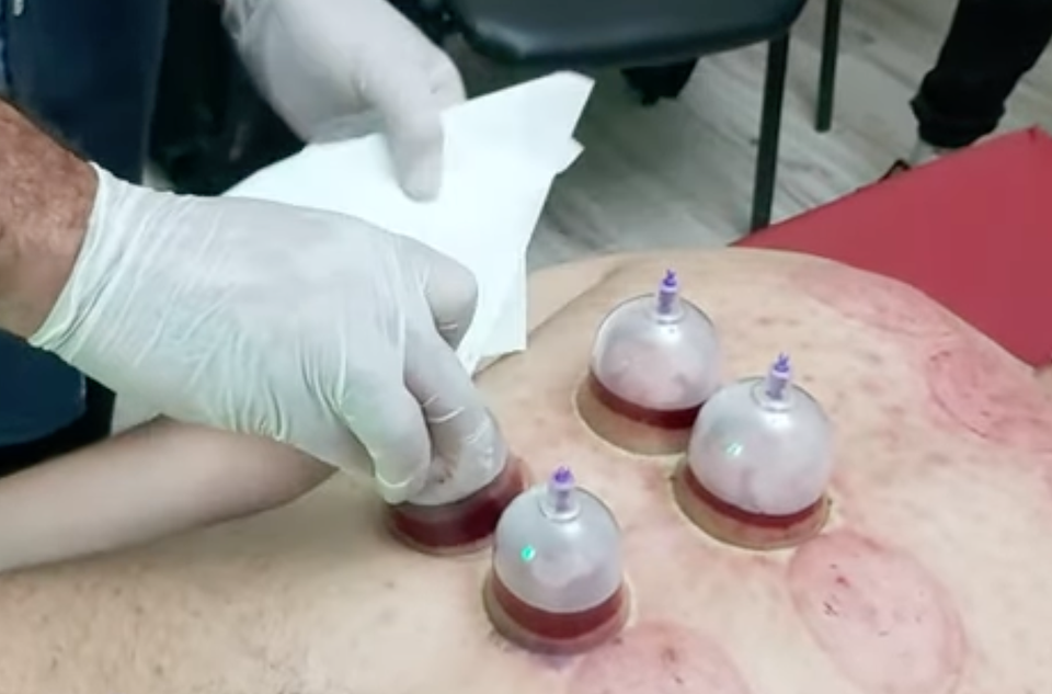 Why I Rarely Recommend Wet Cupping (Hijama) Therapy